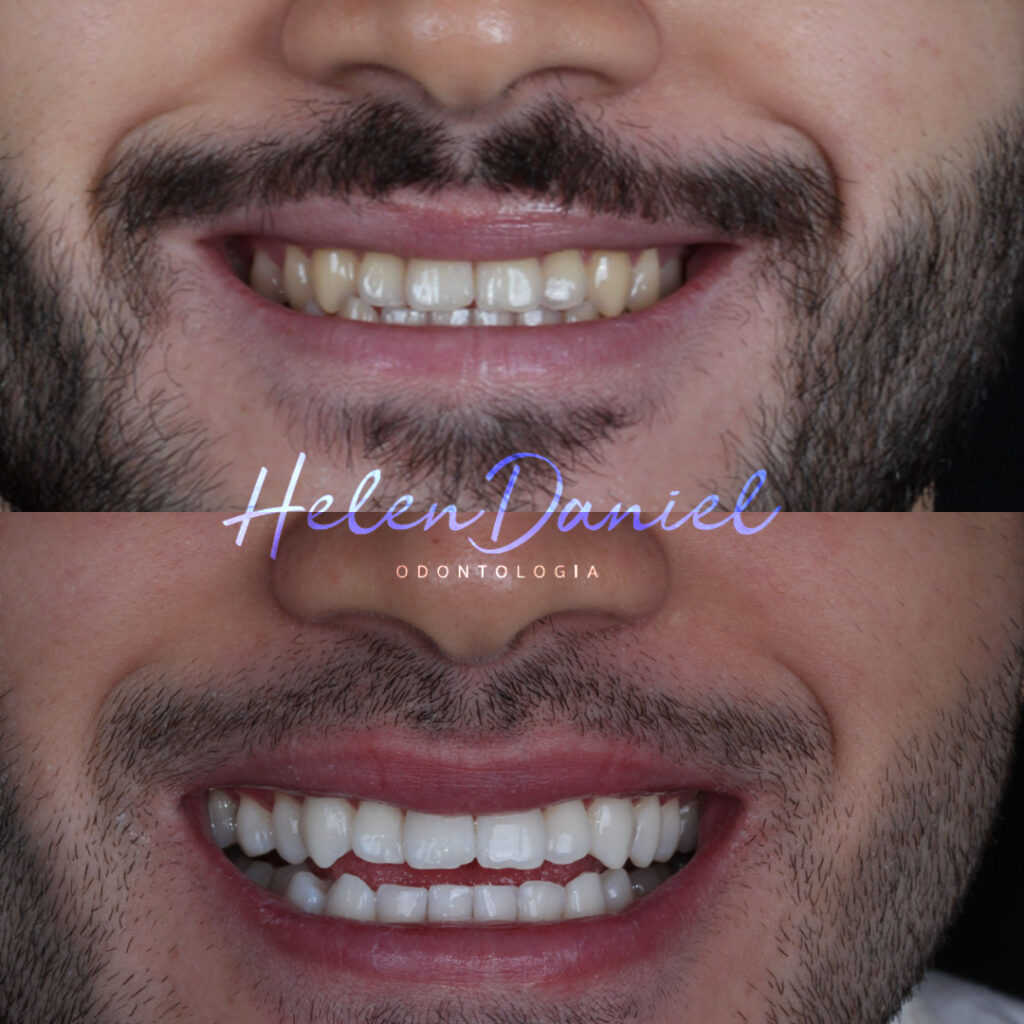 hd2-clareamento