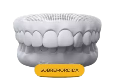 sobrermordida