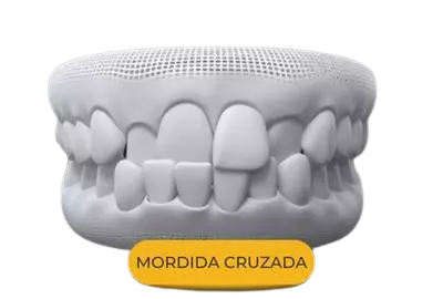Mordida cruzada