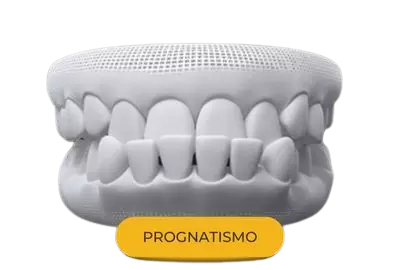prognatismo