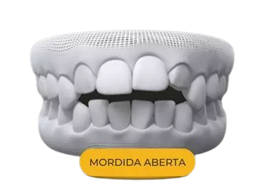 mordida aberta