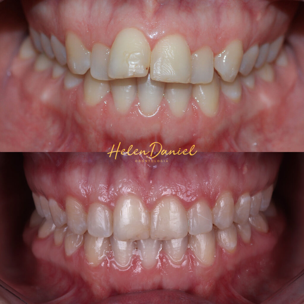 DTM – Dor Orofacial – Helen Daniel