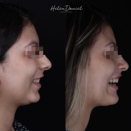 antes e depois 2