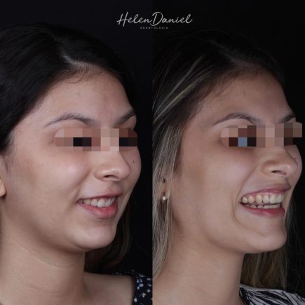 Invisalign  HD Odontologia Em Teresina – Helen Daniel