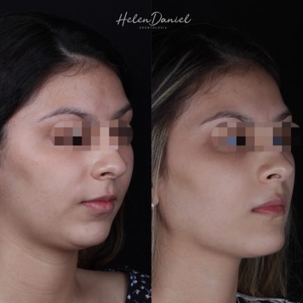 antes e depois